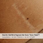 How Do I Get Rid of Ingrown Hair Scars “Down There”