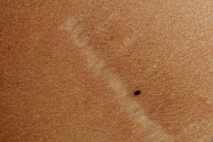 How Do I Get Rid of Ingrown Hair Scars “Down There”