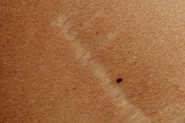 How Do I Get Rid of Ingrown Hair Scars “Down There”